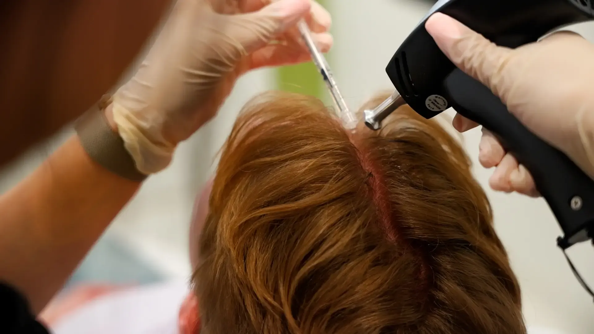 Does Ozempic Cause Hair Loss? A Complete Guide to GLP-1 Hair Shedding, the Real Timeline, and What Actually Works